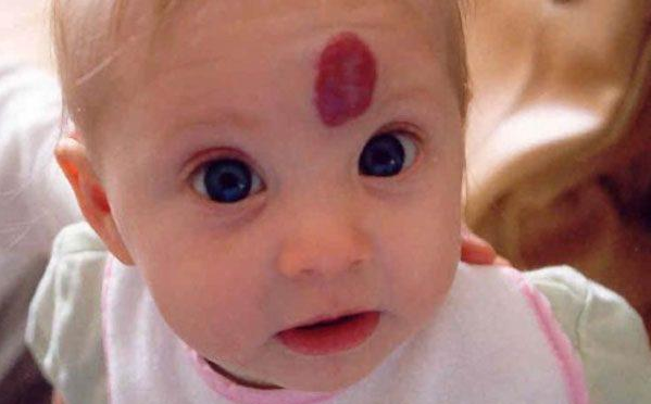 寶寶胎記會自己消失嗎 影響胎記形成的因素