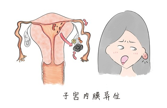 子宮異位癥是什么原因造成的 子宮異位癥的病因