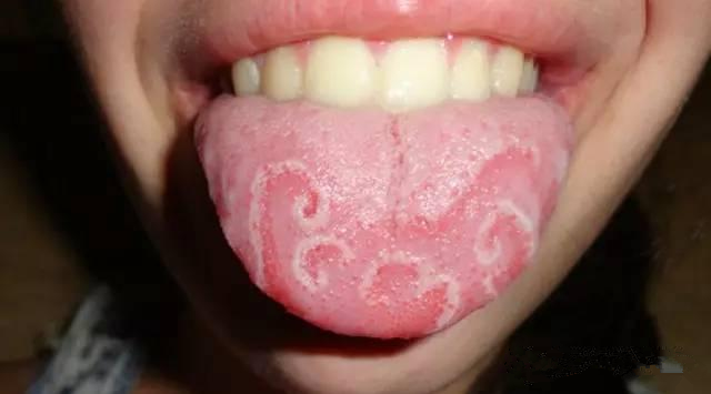 寶寶出現地圖舌是什么原因引起的 寶寶地圖舌怎么緩解