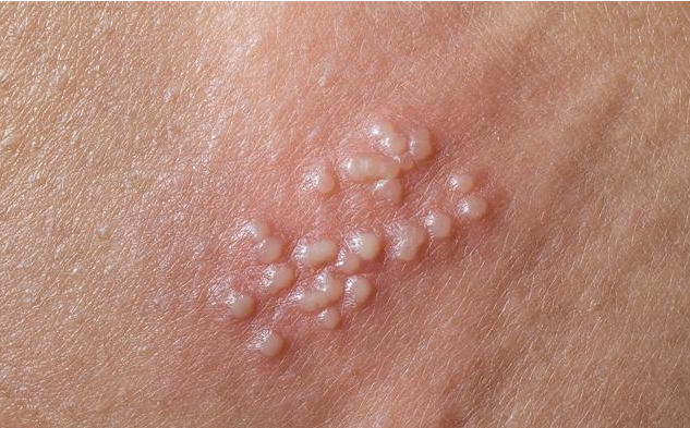 尖銳濕疣會(huì)導(dǎo)致不孕不育嗎 尖銳濕疣治愈需要多久