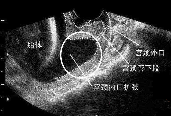 宮頸管短會引發早產嗎 孕期宮頸管短怎么辦