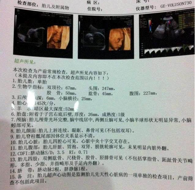 四維彩超什么時候做好 四維彩超怎么看