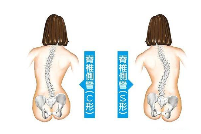 孩子脊柱側彎怎么辦 孩子脊柱側彎治療方法 孩子脊柱側彎怎么辦 孩子脊柱側彎治療方法