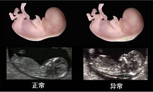 做NT檢查對胎兒有影響嗎 NT檢查異常怎么辦 做NT檢查對胎兒有影響嗎 NT檢查異常怎么辦