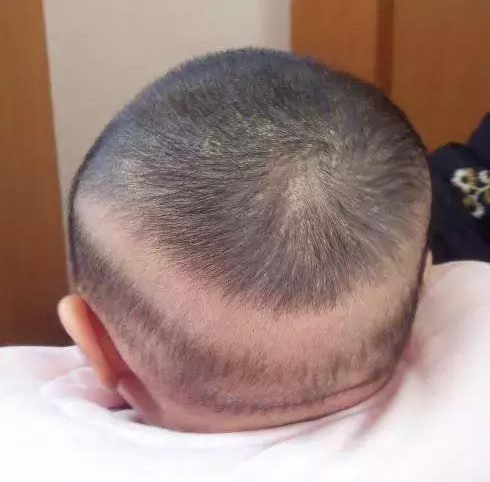 寶寶枕禿就是缺鈣嗎 寶寶枕禿是什么原因