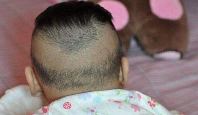 寶寶枕禿就是缺鈣嗎 寶寶枕禿是什么原因