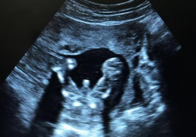 孕囊什么時候可以看到 孕囊發育大小對照表 孕囊什么時候可以看到 孕囊發育大小對照表