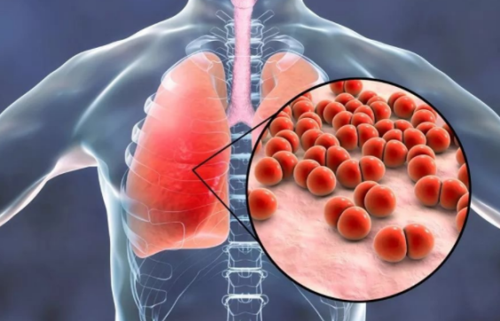 小兒肺炎怎么辨別 小兒肺炎排查方法