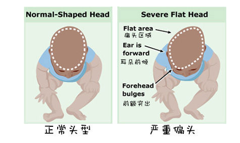寶寶頭型偏長如何睡圓 頭型偏長矯正方法 寶寶頭型偏長如何睡圓 頭型偏長矯正方法