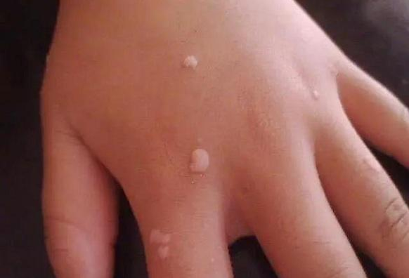 孩子得了扁平疣怎么辦 孩子得了扁平疣治療方法 孩子得了扁平疣怎么辦 孩子得了扁平疣治療方法