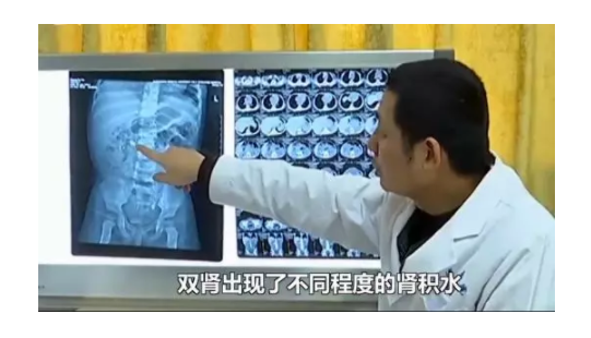 亂補鈣致女嬰長結石是怎么回事 寶寶科學補鈣方法