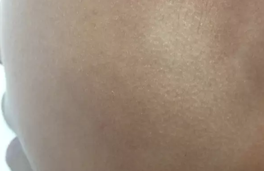 白色糠疹的癥狀表現 白色糠疹預防方法 白色糠疹的癥狀表現 白色糠疹預防方法