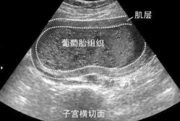 葡萄胎產(chǎn)生的原因是什么 葡萄胎的原因介紹 葡萄胎產(chǎn)生的原因是什么 葡萄胎的原因介紹