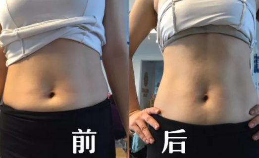 產后腹直肌分離有哪些危害 腹直肌分離的危害