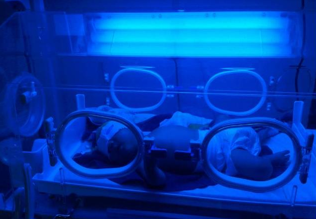 新生兒黃疸照藍光有什么副作用 新生兒黃疸注意事項 新生兒黃疸照藍光有什么副作用 新生兒黃疸注意事項