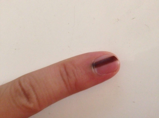 孩子指甲上有黑線是怎么回事 指甲有黑色豎線是得了癌嗎