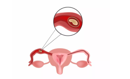 造成宮外孕的原因有哪些 宮外孕的原因介紹