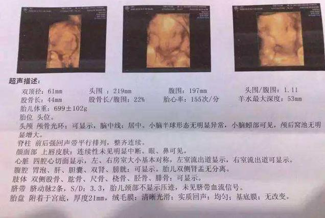 B超做多了會(huì)導(dǎo)致胎兒畸形嗎 B超做多了對(duì)胎兒有影響嗎