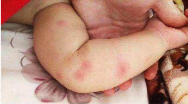 哪些會引起寶寶皮膚過敏 寶寶皮膚過敏護理方法 哪些會引起寶寶皮膚過敏 寶寶皮膚過敏護理方法