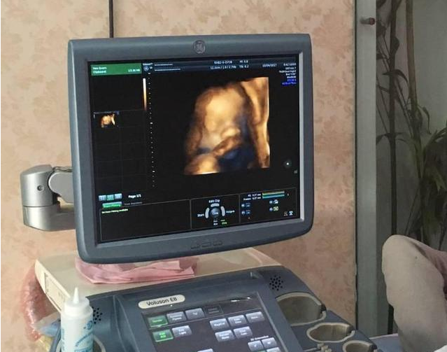 如何讓寶寶配合四維檢查 四維檢查需要做哪些準備 如何讓寶寶配合四維檢查 四維檢查需要做哪些準備