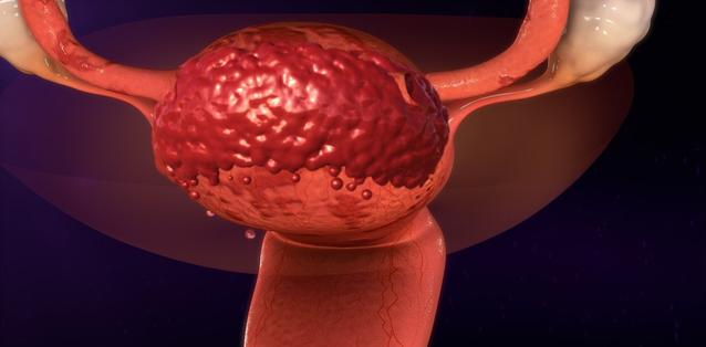 子宮內膜增生會影響懷孕嗎 子宮內膜增生的癥狀表現有哪些