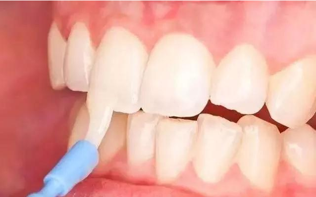 寶寶多大可以涂氟 寶寶涂氟注意事項