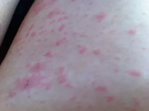 過敏性濕疹怎么治療 過敏性濕疹的治療方法 過敏性濕疹怎么治療 過敏性濕疹的治療方法