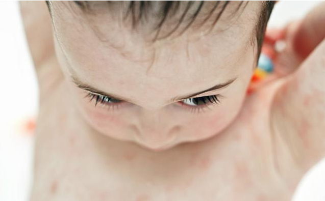 寶寶濕疹反復(fù)不好是怎么回事 寶寶濕疹反復(fù)不好的原因