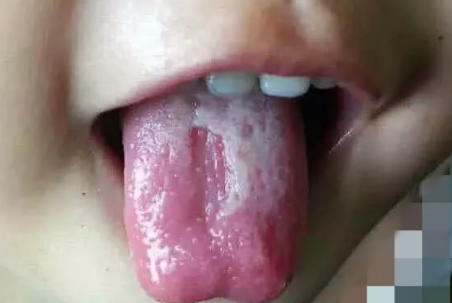 寶寶地圖舌有哪些癥狀 寶寶地圖舌的癥狀