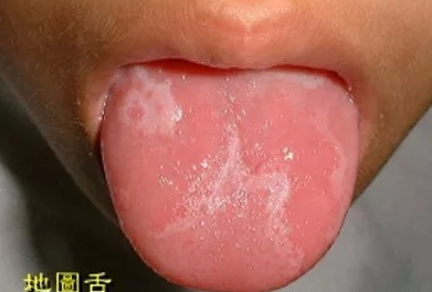 寶寶地圖舌怎么辦 寶寶地圖舌治療方法 寶寶地圖舌怎么辦 寶寶地圖舌治療方法