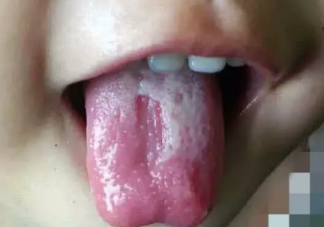 寶寶地圖舌有哪些癥狀 寶寶地圖舌的癥狀