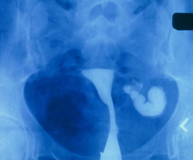 備孕檢查做輸卵管造影疼嗎 影響輸卵管造影疼痛的因素 備孕檢查做輸卵管造影疼嗎 影響輸卵管造影疼痛的因素