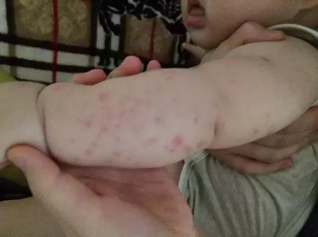 春節(jié)寶寶螨蟲過敏怎么辦 春節(jié)除螨蟲的方法