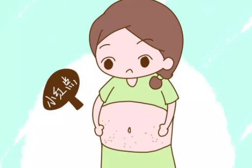 妊娠紋長之前有哪些癥狀 孕婦長妊娠紋的前兆