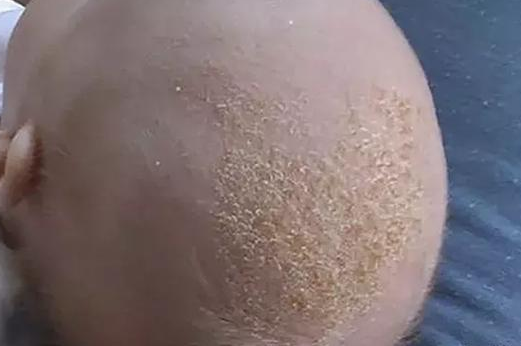 寶寶乳痂怎么去掉 寶寶乳痂清理方法