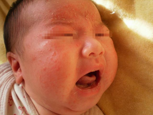寶寶發(fā)生奶癬的原因 寶寶有奶癬怎么辦 寶寶發(fā)生奶癬的原因 寶寶有奶癬怎么辦