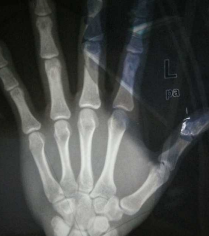 孩子骨齡偏小怎么辦 孩子骨齡偏小解決方法