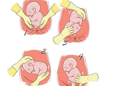 胎位不正能做糾正操嗎 胎位不正怎么糾正 胎位不正能做糾正操嗎 胎位不正怎么糾正