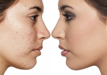 懷孕為什么臉上會長痘 孕期臉上長痘怎么辦 懷孕為什么臉上會長痘 孕期臉上長痘怎么辦