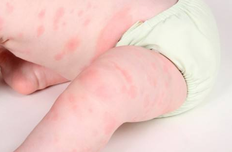 造成孩子過敏體質的原因 過敏體質是什么原因造成的