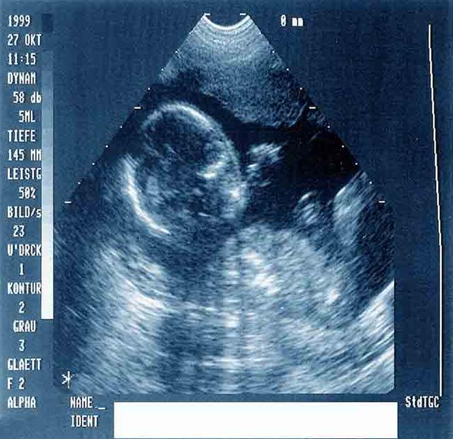 懷孕后什么時(shí)候有胎心 懷孕后沒胎心怎么辦