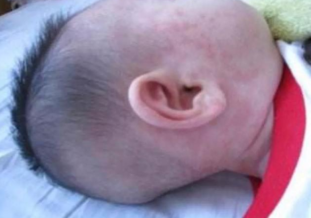 寶寶第一次發(fā)高燒是幼兒急疹嗎 寶寶幼兒急疹怎么護理