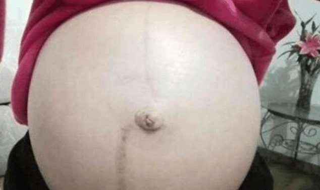 懷孕妊娠線長歪了是怎么回事 妊娠線長歪了是男是女 懷孕妊娠線長歪了是怎么回事 妊娠線長歪了是男是女