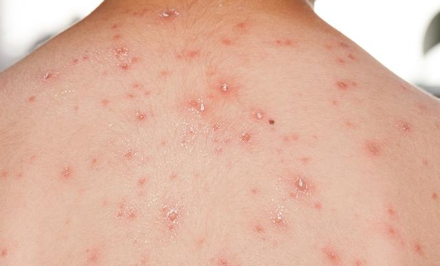 如何預防春季孩子長水痘 春季孩子長水痘的護理方法