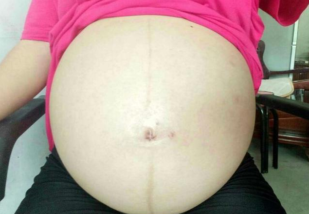 封閉抗體陰性患者怎么做試管嬰兒 封閉抗體陰性懷孕怎么保胎