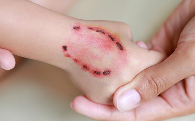 9歲男童被狗舔手后死亡是真的嗎 被狗舔也會得狂犬病嗎 9歲男童被狗舔手后死亡是真的嗎 被狗舔也會得狂犬病嗎