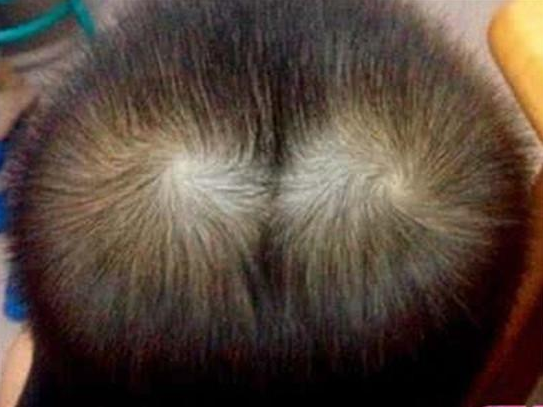 孩子頭旋越多脾氣大嗎 孩子頭旋和性格有什么關系