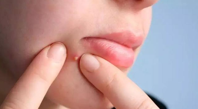 強迫性皮膚剝離癥的表現 強迫性皮膚剝離癥是怎么回事