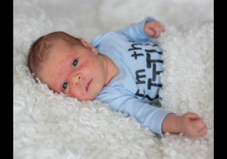 寶寶濕疹反復怎么辦 寶寶濕疹你知道該怎么護理嗎