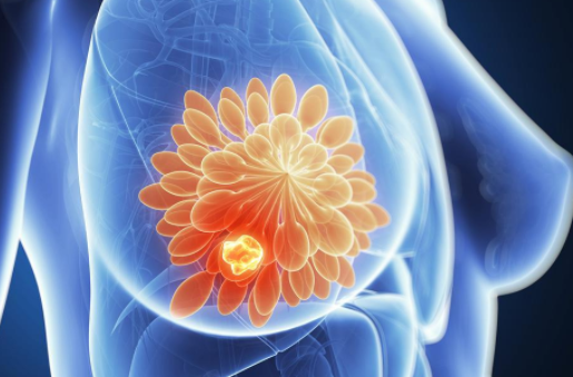 急性乳腺炎怎么預防 急性乳腺炎預防方法 急性乳腺炎怎么預防 急性乳腺炎預防方法